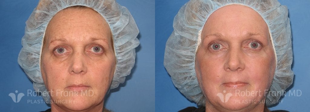 Patient a laser resurfacing before and after | robert frank md