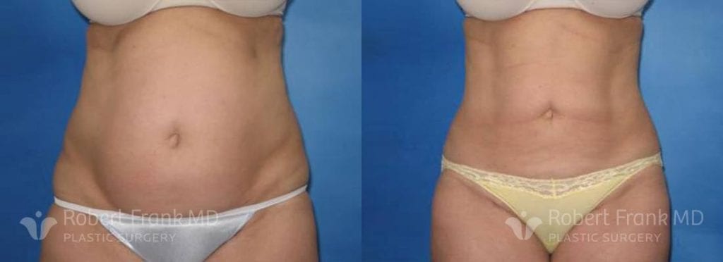 Liposuction Before and After Patient