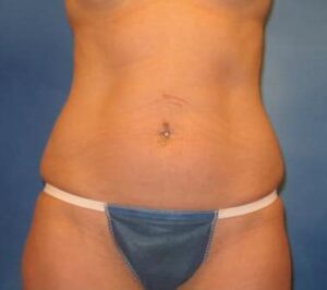 Patient g after tummy tuck front view | robert frank md