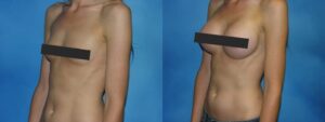Breast augmentation before and after comparison | robert frank md