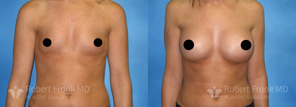 Breast Augmentation Before and After Patient