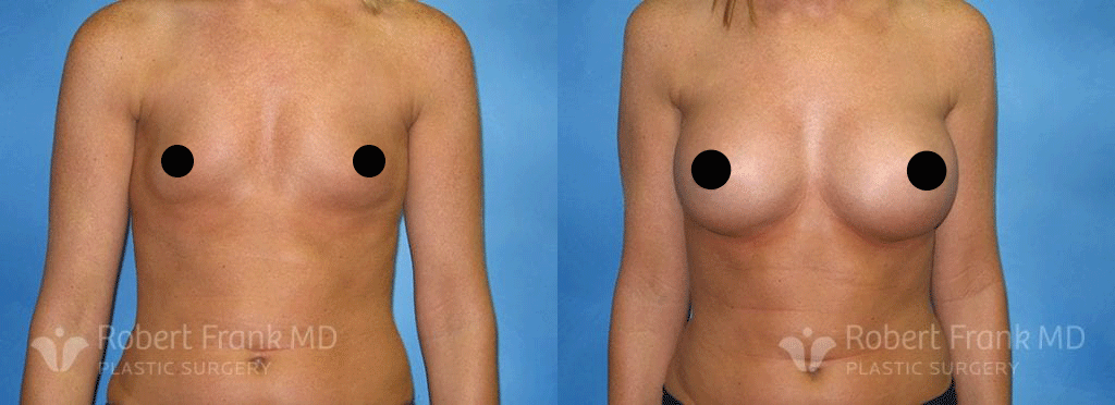 Breast augmentation before and after patient | robert frank md