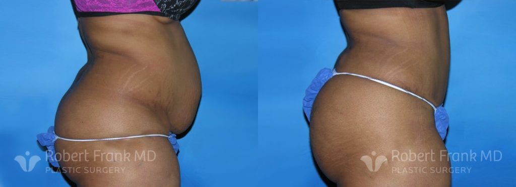 Patient a brazilian butt lift before and after | robert frank md