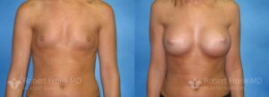 Breast Augmentation Before and After Photo 1