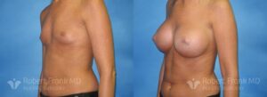 Breast Augmentation Before and After Photo 2