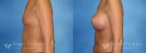 Breast Augmentation Before and After Photo 3
