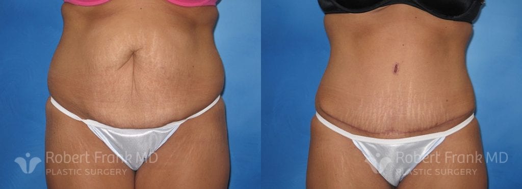 Tummy Tuck Before and After Patient