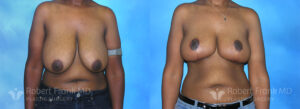 robert-frank-munster-hobart-breast-reduction-patient-2-1